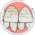 四環(huán)素牙